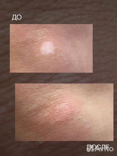 Удаление рубцов/шрамов/растяжек/витилиго /ареолы