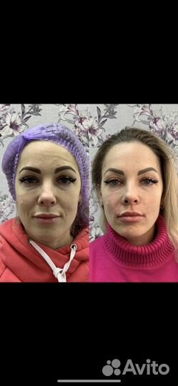 Косметолг Ботокс /бьютификация /липолитики