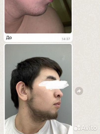 Minoxidil(Миноксидил) Kirkland 5 +пипетка