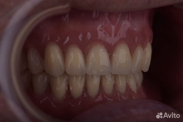 Зубные протезы