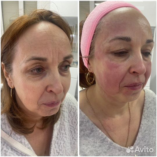 Аппарат для СМАС лифтинга