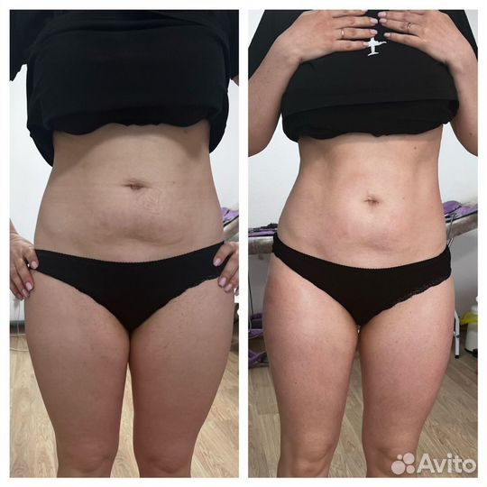 Коррекция фигуры (жиротоп, вибромассаж,ваккуум)