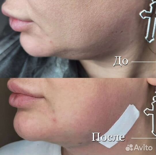 Подтяжка лица нитями ког мезонити моно