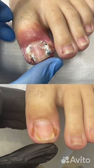 Подолог . Вросший ноготь