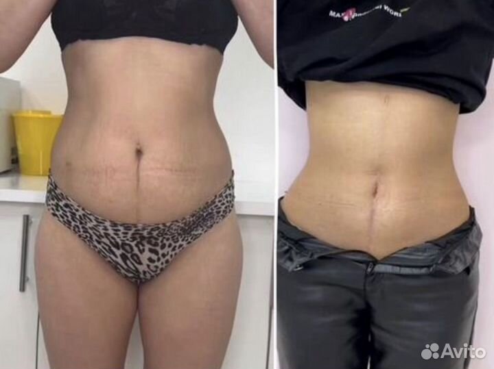 Криолиполиз, идеальная фигура без диет