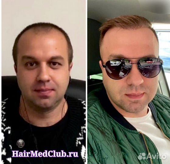 Пересадка волос без рубцов, швов и шрамов