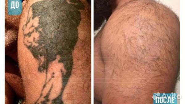 Удаление тату и татуажа