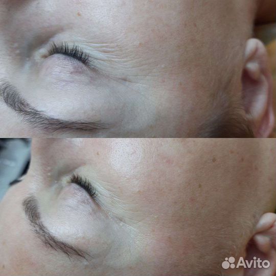 Аппаратная косметология