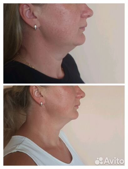 Массаж лица