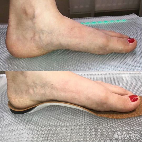 Изготовление индивидуальных ортопедических стелек