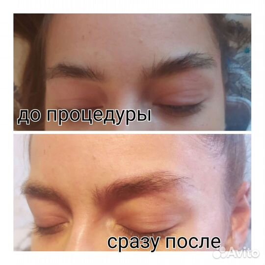 Удаление тату и татуажа лазером, карбоновый пилинг