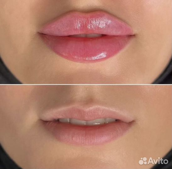 Увеличение губ