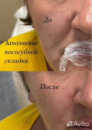 Увеличение губ/Косметолог/ ботокс