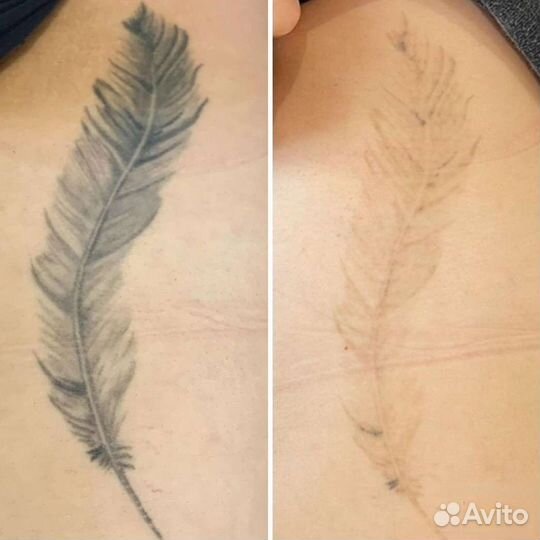 Лазерное удаление тату и татуажа