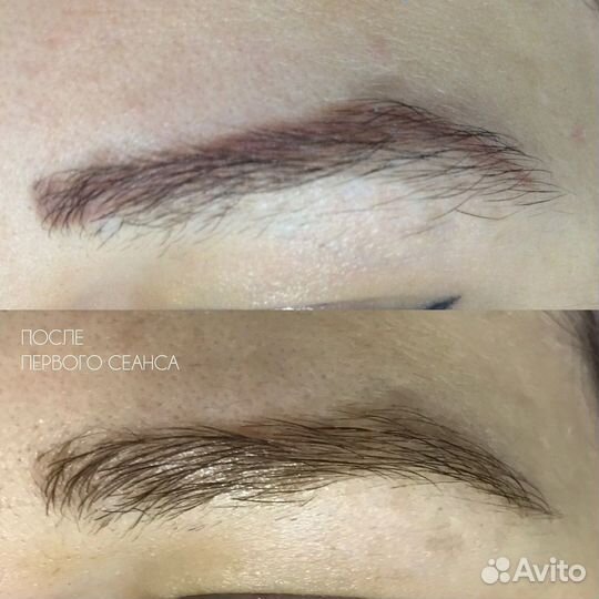 Модели на лазерное удаление татуажа бровей