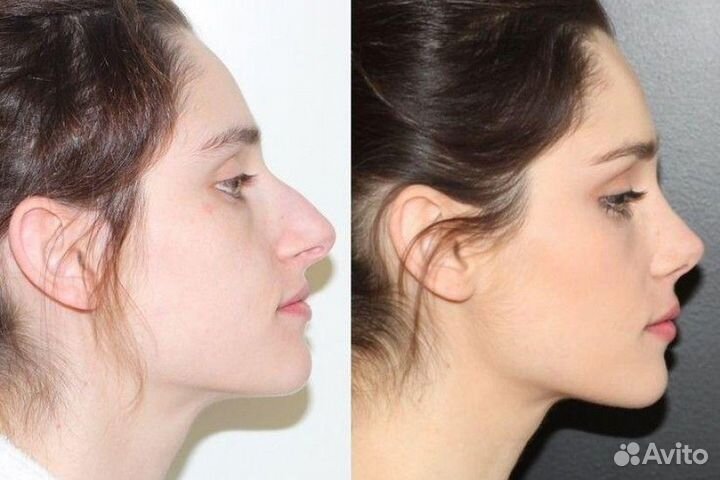 Модели на Бесплатную Ринопластику