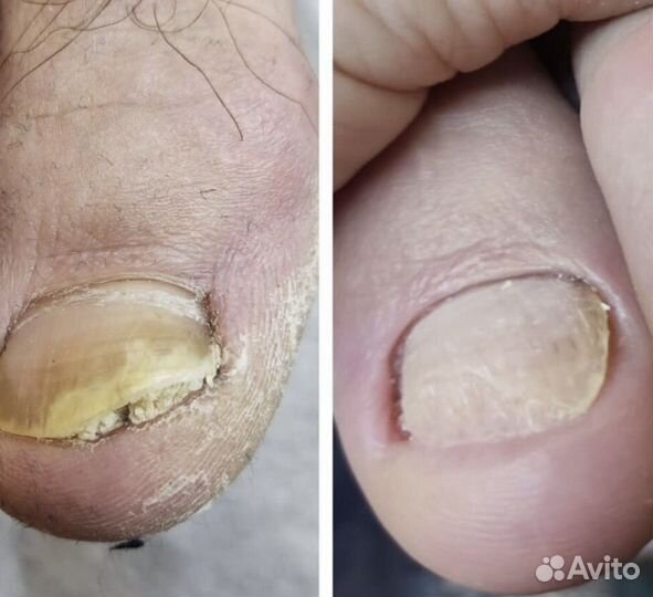 Медицинский педикюр. Подолог