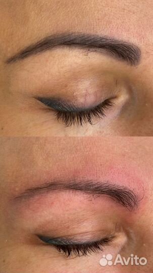 Лазерное удаления тату/татуажа/ /обучение/ модели