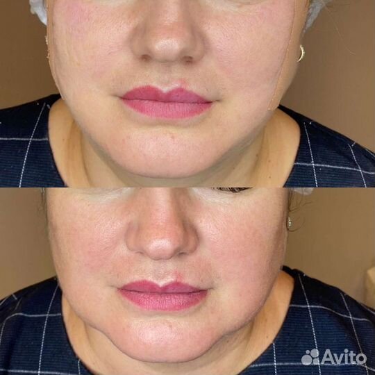 Увеличение губ