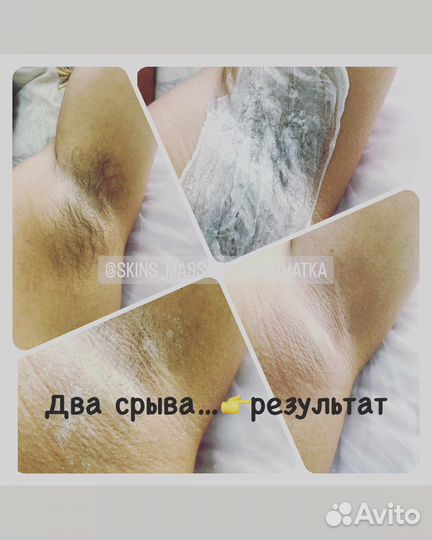 Депиляция воском: глубокое бикини