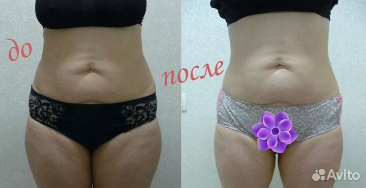 Модель на антицеллюлитный массаж