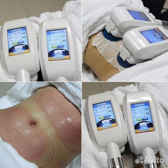 Процедура криолиполиз