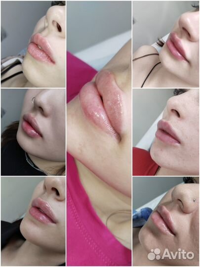 Увеличение губ,Ботокс,Липолитик,Биоревитализация