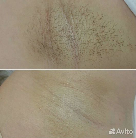 Шугаринг Воск СПб Девяткино