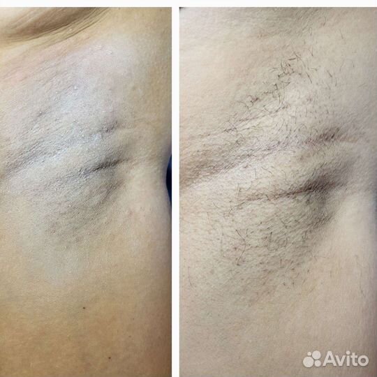 Электроэпиляция