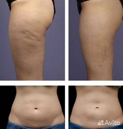 Прессотерапия