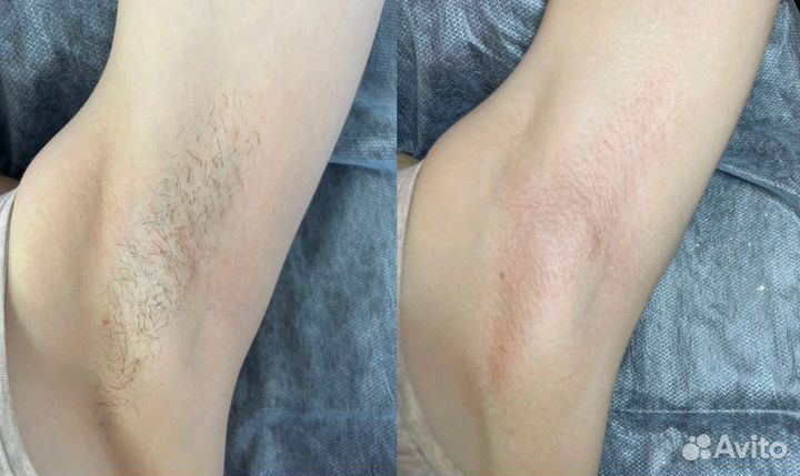 Шугаринг/воск/депиляция