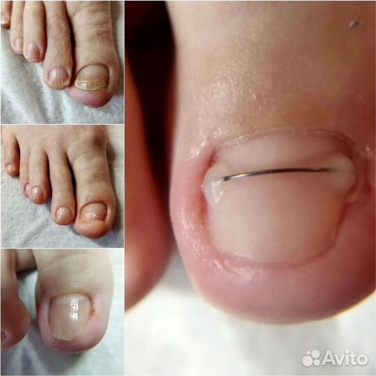 Лечебный педикюр подолог