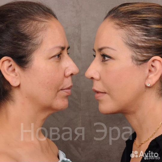 Ультра омоложение /подтяжка лица/ Минус 15 лет за