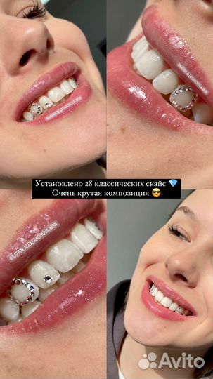Установка скайсов