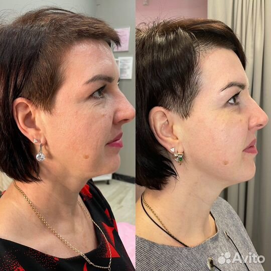 Rf лифтинг лица