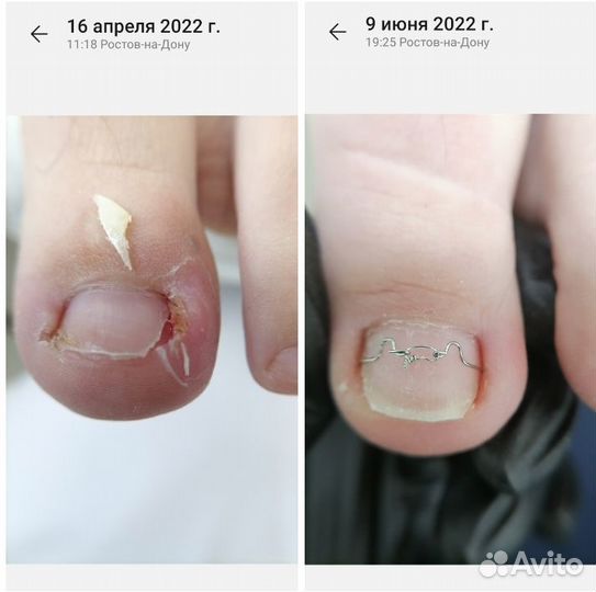 Вросший ноготь, Подология, Педикюр