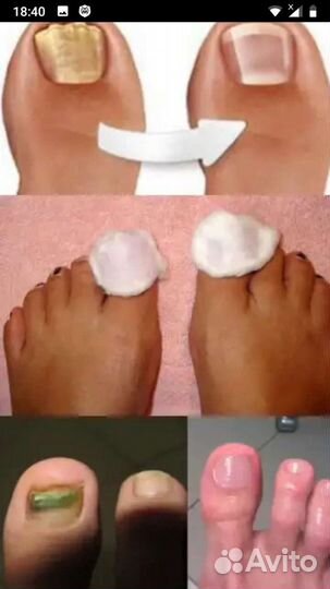 Медицинский педикюр