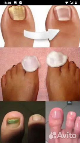Медицинский педикюр