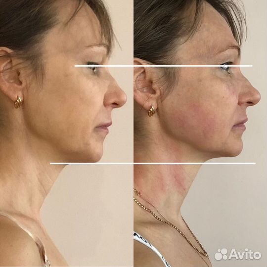 Фейспластика