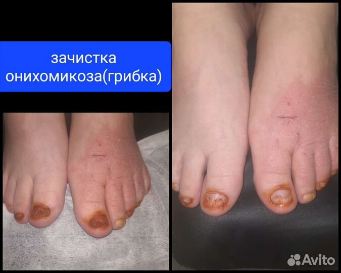 Подолог С мед. образованием, выезд на дом, педикюр