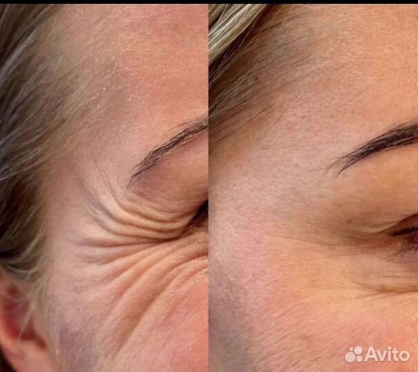 День ботокса Релатокс