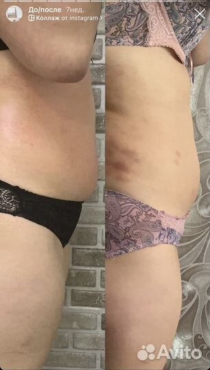 Аппаратный массаж