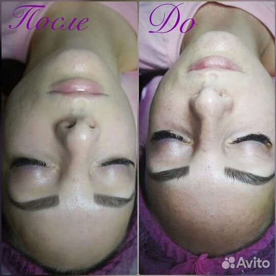 Процедура Фарфоровая куколка