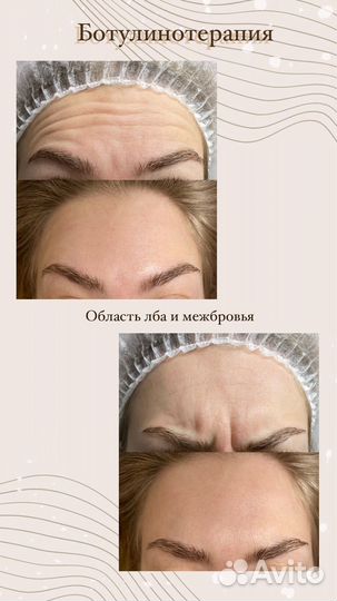 Врач косметолог/ Увеличение губ/ Ботокс