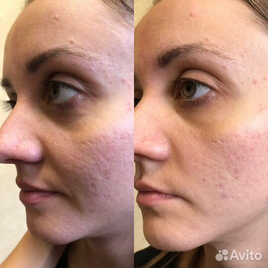 Скульптурный массаж лица