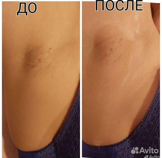 Восковая депиляция