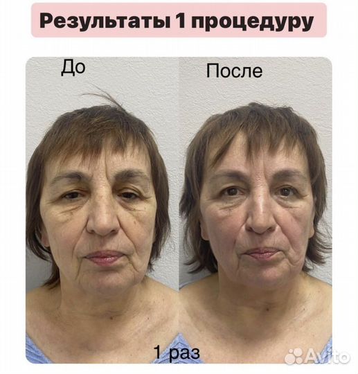 Сплит массаж лица в Ялте