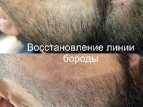 Выравнивание бородыТрихопигментация (SMP)