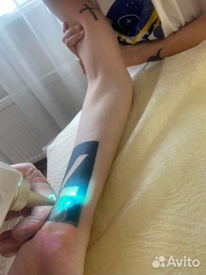 Удаление татуировок, татуажа