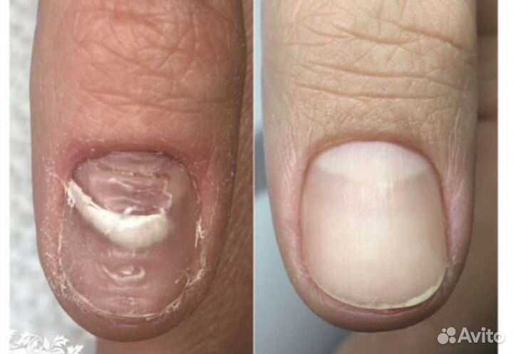 Лечебный педикюр подолог